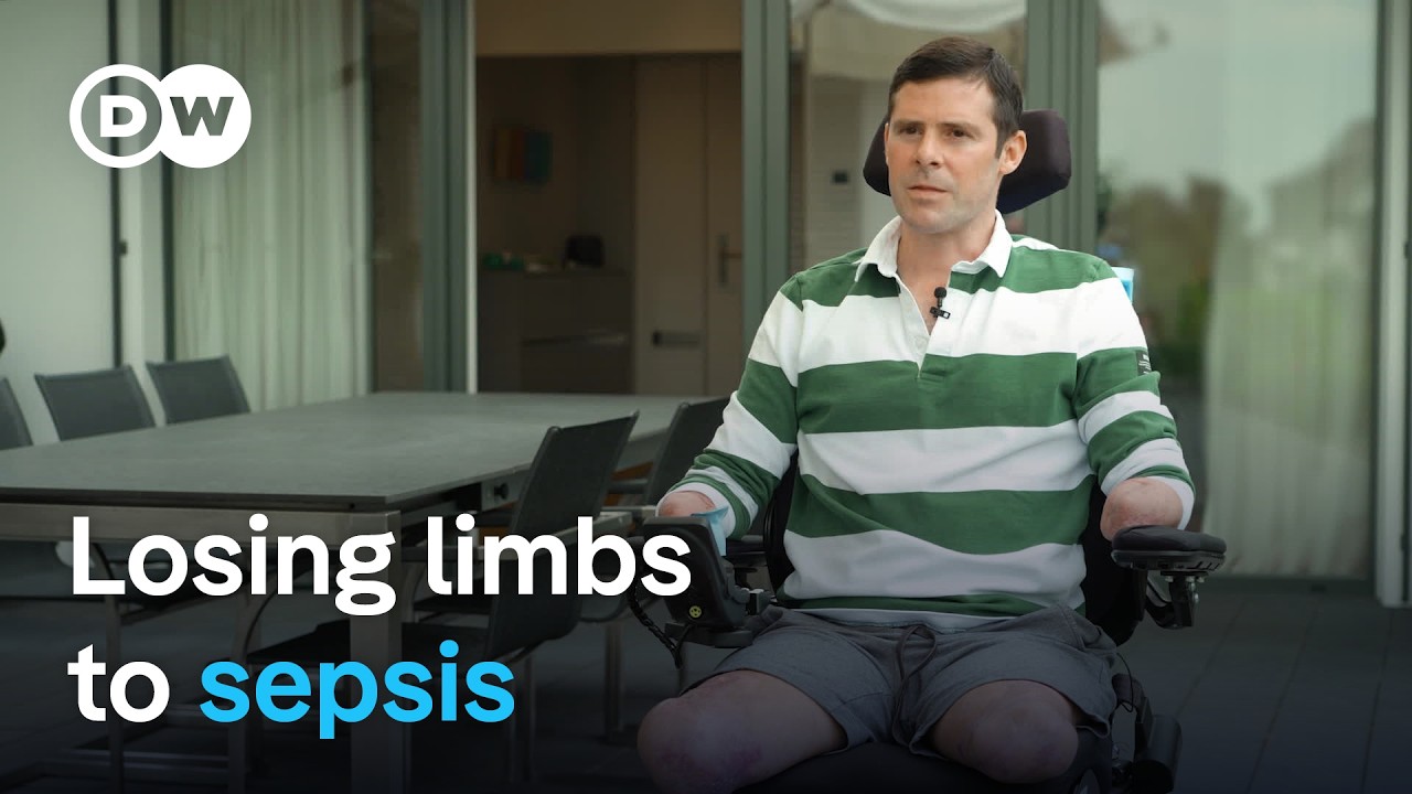 Perda De Membros Por Sepse
